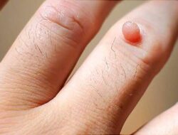 Bukan Hanya Perempuan, Lelaki Juga Berisiko Terinfeksi HPV